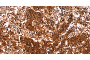 Immunohistochemistry of paraffin-embedded Human gastric cancer using HAS1 Polyclonal Antibody at dilution of 1:30 (HAS1 Antikörper)