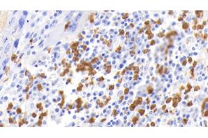 Detection of CALPRO in Human Lymphoma Tissue using Polyclonal Antibody to Calprotectin (CALPRO) (S100A8/A9 Complex (Calprotectin) Antikörper  (AA 1-114))