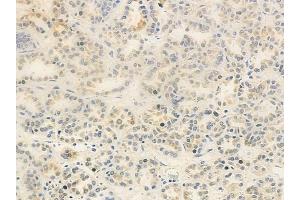 ABIN6263150 and ABIN6278791 at 1/100 staining human renal cell carcinoma by IHC-P. (MBIP Antikörper  (Internal Region))