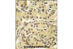 Formalin-fixed and paraffin-embedded human prostata carcinoma tissue reacted with TIEG antibody , which was peroxidase-conjugated to the secondary antibody, followed by DAB staining. (KLF10/TIEG1 Antikörper  (N-Term))