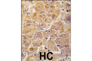 Formalin-fixed and paraffin-embedded human hepatocellular carcinoma reacted with ALDH1A1 polyclonal antibody  , which was peroxidase-conjugated to the secondary antibody, followed by DAB staining. (ALDH1A1 Antikörper  (Internal Region))