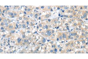 Immunohistochemistry of paraffin-embedded Human liver cancer tissue using PLXNA2 Polyclonal Antibody at dilution 1:40 (Plexin A2 Antikörper)