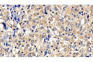 Detection of Bcl2L2 in Human Liver cancer Tissue using Polyclonal Antibody to B-Cell CLL/Lymphoma 2 Like Protein 2 (Bcl2L2)