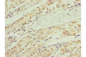 Immunohistochemistry of paraffin-embedded human gastric cancer using ABIN7151148 at dilution of 1:100 (RNF135 Antikörper  (AA 339-432))