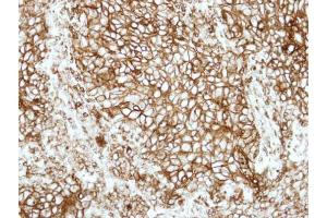 IHC-P Image Immunohistochemical analysis of paraffin-embedded human lung adenocarcinoma, using HLA-DRB1, antibody at 1:500 dilution.