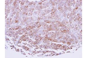 IHC-P Image Immunohistochemical analysis of paraffin-embedded human breast cancerncer, using ICAM2, antibody at 1:100 dilution. (ICAM2 Antikörper)