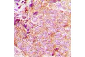 Immunohistochemical analysis of CaMKK beta staining in human breast cancer formalin fixed paraffin embedded tissue section. (CAMKK2 Antikörper)