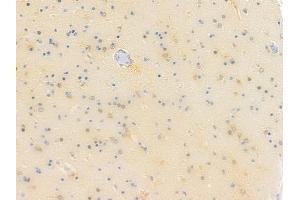 ABIN6257252 and ABIN6273611 at 1/100 staining human glioblastoma by IHC-P.