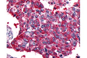 Anti-CALCRL / CGRP Receptor antibody IHC of human Lung, Non-Small Cell Carcinoma. (CALCRL Antikörper  (Cytoplasmic Domain))