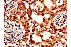 Immunohistochemistry of paraffin-embedded human lung cancer using ABIN7169181 at dilution of 1:100 (SIK1 Antikörper  (AA 492-750))