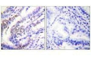 Immunohistochemical analysis of paraffin-embedded human lung carcinoma tissue using Cyclin E1 antibody. (Cyclin E1 Antikörper)