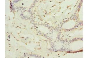 Immunohistochemistry of paraffin-embedded human breast cancer using ABIN7157236 at dilution of 1:100 (KATNAL2 Antikörper  (AA 18-307))
