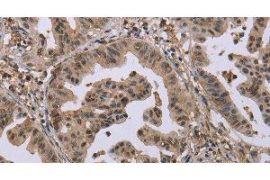 Immunohistochemistry of paraffin-embedded Human gastric cancer tissue using MCC Polyclonal Antibody at dilution 1:30 (MCC Antikörper)
