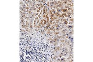 Immunohistochemical analysis of paraffin-embedded Human hepatocarcinoma tissue using (ABIN654629 and ABIN2844325) performed on the Leica® BOND RXm. (BCKDHB Antikörper  (N-Term))