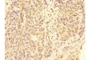 Immunohistochemistry of paraffin-embedded human ovarian cancer using ABIN7158545 at dilution of 1:100 (FCGR2C Antikörper  (AA 43-223))