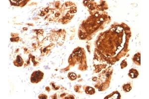 Formalin-fixed, paraffin-embedded human Breast Carcinoma stained with MUC1 Mouse Recombinant Monoclonal Antibody (rMUC1/960). (Rekombinanter MUC1 Antikörper)