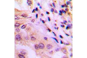 Immunohistochemical analysis of p65 (pT60) staining in human lung cancer formalin fixed paraffin embedded tissue section. (SYT1 Antikörper  (N-Term, pSer60))