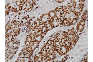 Immunostaining (ISt) image for anti-Progesterone Receptor (PGR) (AA 1-110) antibody (ABIN562204)