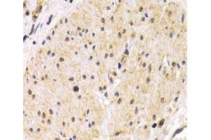 Immunohistochemistry of paraffin-embedded Human stomach cancer using TMPRSS2 Polyclonal Antibody at dilution of 1:200 (40x lens). (TMPRSS2 Antikörper)