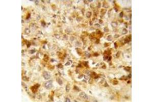 Immunohistochemistry analysis of human hepatocarcinoma (Formalin-fixed, Paraffin-embedded)  using Peroxin 2 / PEX2 / RNF72  Antibody , followed by peroxidase-conjugated secondary antibody and DAB staining. (PEX2 Antikörper  (Middle Region))