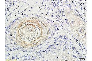 Formalin-fixed and paraffin embedded human oral squamous cell carcinoma labeled with Anti-IL-17 Polyclonal Antibody, Unconjugated (ABIN677933) at 1:200 followed by conjugation to the secondary antibody and DAB staining