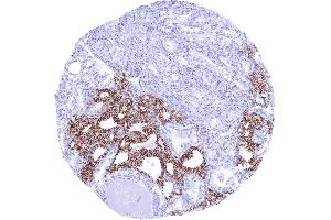 Thyroid CDH16 negative papillary carcinoma invading CDH16 positive normal thyroid CDH16 immunohistochemistry (Rekombinanter Cadherin-16 Antikörper)