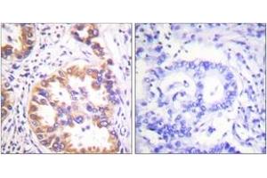 Immunohistochemistry analysis of paraffin-embedded human lung carcinoma, using Tuberin/TSC2 (Phospho-Ser939) Antibody. (Tuberin Antikörper  (pSer939))