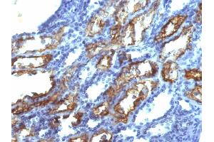 Formalin-fixed, paraffin-embedded human Renal Cell Carcinoma stained with Interferon gamma Mouse Monoclonal Antibody (IFNG/466). (Interferon gamma Antikörper)