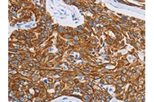 The image on the left is immunohistochemistry of paraffin-embedded Human esophagus cancer tissue using ABIN7191483(MMP21 Antibody) at dilution 1/15, on the right is treated with synthetic peptide. (MMP21 Antikörper)