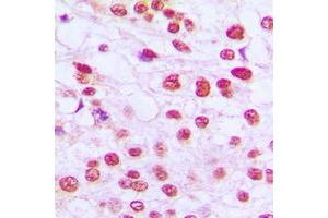 Immunohistochemical analysis of RB1 staining in human breast cancer formalin fixed paraffin embedded tissue section.