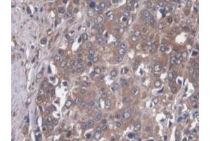 DAB staining on IHC-P; Samples: Human Prostate cancer Tissue (MAP4 Antikörper  (AA 243-549))