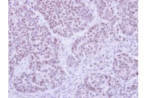 IHC-P Image Immunohistochemical analysis of paraffin-embedded SW480 xenograft , using FHL5, antibody at 1:500 dilution. (FHL5 Antikörper)