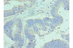 Immunohistochemistry of paraffin-embedded human colon cancer using ABIN7144450 at dilution of 1:100 (BCL2L14 Antikörper  (AA 1-327))
