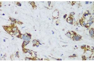 Immunohistochemistry of paraffin-embedded Human gastric cancer using ECH1 Polyclonal Antibody at dilution of 1:150 (40x lens). (ECH1 Antikörper)