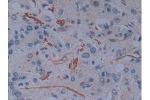 Detection of PLS3 in Human Prostate cancer Tissue using Polyclonal Antibody to Plastin 3 (PLS3) (Plastin 3 Antikörper  (AA 379-630))