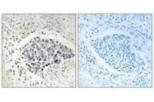Immunohistochemistry analysis of paraffin-embedded human lung carcinoma tissue using CPNE8 antibody. (CPNE8 Antikörper  (N-Term))