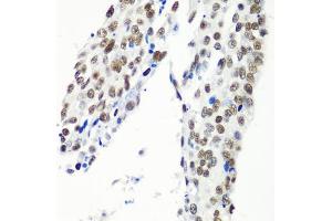 Immunohistochemistry of paraffin-embedded human lung cancer using HT antibody  at dilution of 1:100 (40x lens). (HTATSF1 Antikörper  (AA 1-270))
