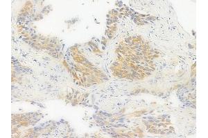ABIN6256392 and ABIN6267376 at 1/100 staining human lung squamous cell carcinoma by IHC-P. (Glycogen Synthase Antikörper  (pSer645))