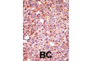 Formalin-fixed and paraffin-embedded human cancer tissue reacted with MGAT3 polyclonal antibody  , which was peroxidase-conjugated to the secondary antibody, followed by AEC staining . (MGAT3 Antikörper  (N-Term))
