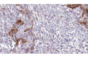 ABIN6277553 at 1/100 staining Human urothelial cancer tissue by IHC-P.