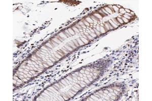 ABIN6267547 at 1/200 staining human colon cancer tissue sections by IHC-P. (VASP Antikörper  (pSer239))
