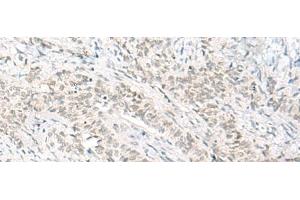 Immunohistochemistry of paraffin-embedded Human ovarian cancer tissue using HABP4 Polyclonal Antibody at dilution of 1:60(x200) (HABP4 Antikörper)
