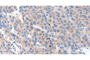 Immunohistochemistry of paraffin-embedded Human liver cancer tissue using KLK2 Polyclonal Antibody at dilution 1:100 (Kallikrein 2 Antikörper)