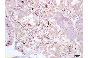 Formalin-fixed and paraffin embedded human lung carcinoma labeled with Rabbit Anti-FAK gamma Polyclonal Antibody (ABIN675189) at 1:200 followed by conjugation to the secondary antibody and DAB staining. (FAK Antikörper  (AA 901-1052))