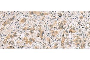 Immunohistochemistry of paraffin-embedded Human liver cancer tissue using RTP4 Polyclonal Antibody at dilution of 1:80(x200) (RTP4 Antikörper)