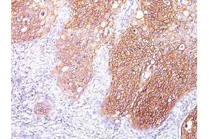 Formalin-fixed, paraffin-embedded human Lung SqCC stained with EGFR Mouse Monoclonal Antibody (GFR/1667). (EGFR Antikörper)