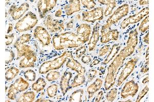 ABIN6257582 and ABIN6275689 at 1/100 staining Human kidney cancer and adjacent normal tissues by IHC-P. (ZFYVE19 Antikörper  (Internal Region))