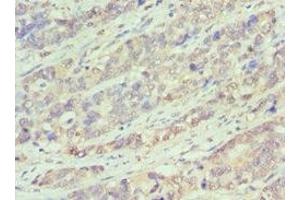 Immunohistochemistry of paraffin-embedded human endometrial cancer using ABIN7145167 at dilution of 1:100 (Cyclin D1 Antikörper  (AA 1-233))