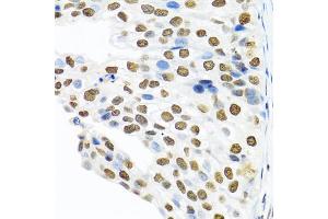 Immunohistochemistry of paraffin-embedded human prostate cancer using PTBP1 antibody (ABIN5995415) at dilution of 1/100 (40x lens). (PTBP1 Antikörper)