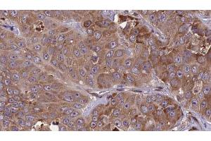 ABIN6273840 at 1/100 staining Human liver cancer tissue by IHC-P. (CCR1 Antikörper  (N-Term))